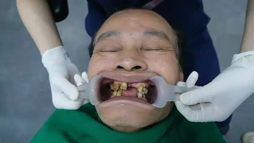 Phục hồi răng mất - Thanh toán sau: Giải pháp tài chính thông minh cho bạn
