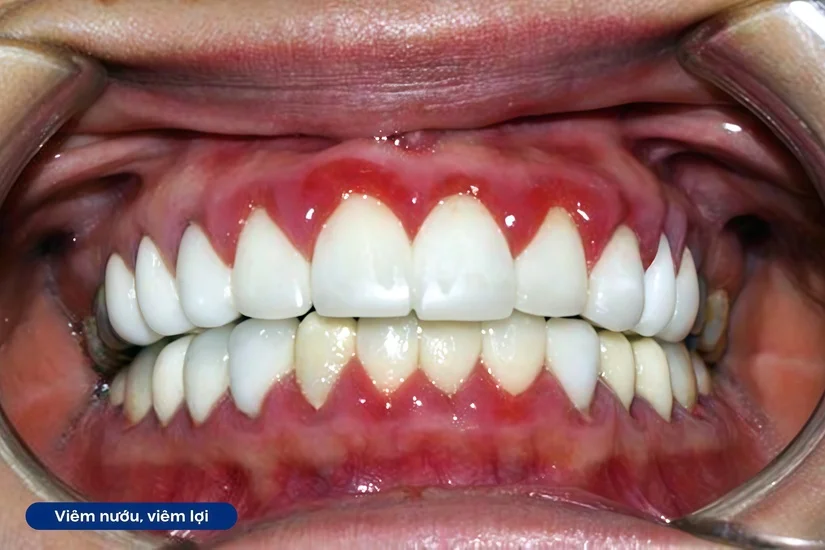 Răng sứ bị ê buốt sau khi làm: nguyên nhân và khi nào cần đi kiểm tra