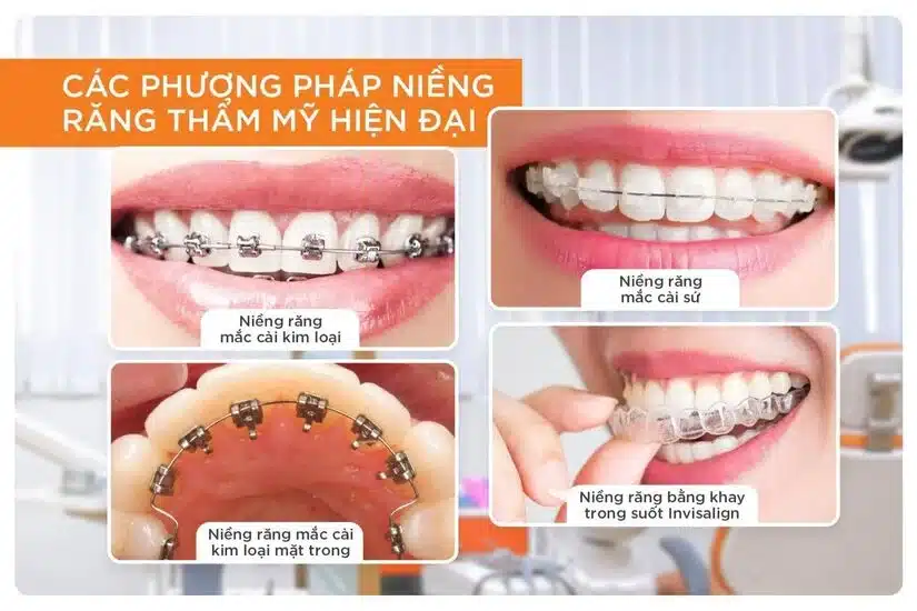 So sánh chi phí niềng răng: kim loại – sứ – tự buộc – trong suốt