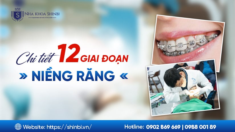 Các giai đoạn niềng răng từ A–Z (12 giai đoạn quan trọng)