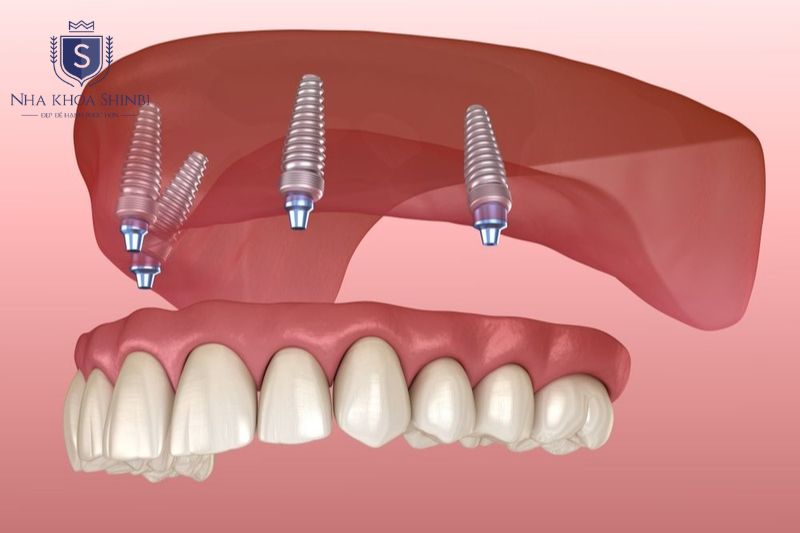 Hệ 4 trụ implant gồm 2 thẳng và 2 nghiêng giúp phân bổ lực nhai