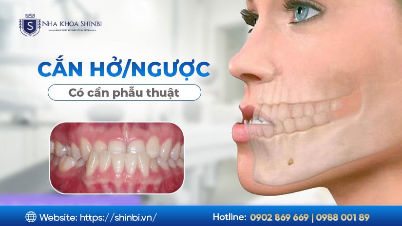 Niềng răng cho khớp cắn hở / cắn ngược: mức độ nào cần phẫu thuật?
