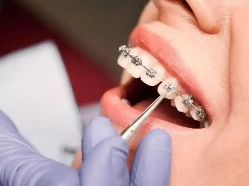 Niềng răng mắc cài kim loại: cấu tạo – chi phí – đối tượng phù hợp