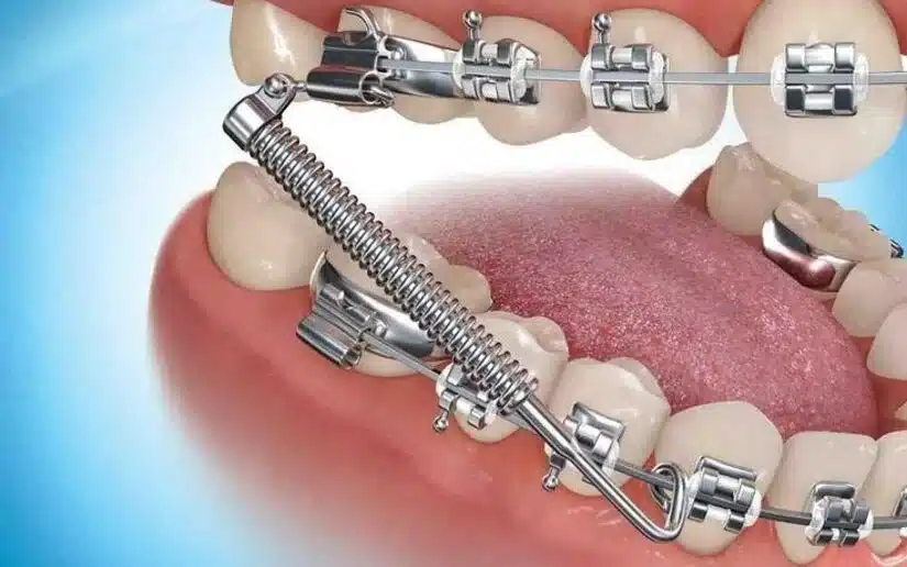 Niềng răng mắc cài kim loại: cấu tạo – chi phí – đối tượng phù hợp
