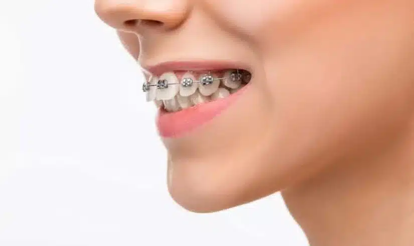 Niềng răng mắc cài kim loại: cấu tạo – chi phí – đối tượng phù hợp