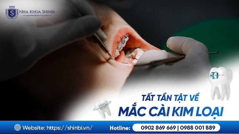 Niềng răng mắc cài kim loại: cấu tạo – chi phí – đối tượng phù hợp