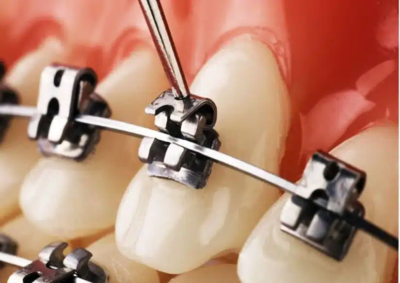 Niềng răng mắc cài kim loại: cấu tạo – chi phí – đối tượng phù hợp