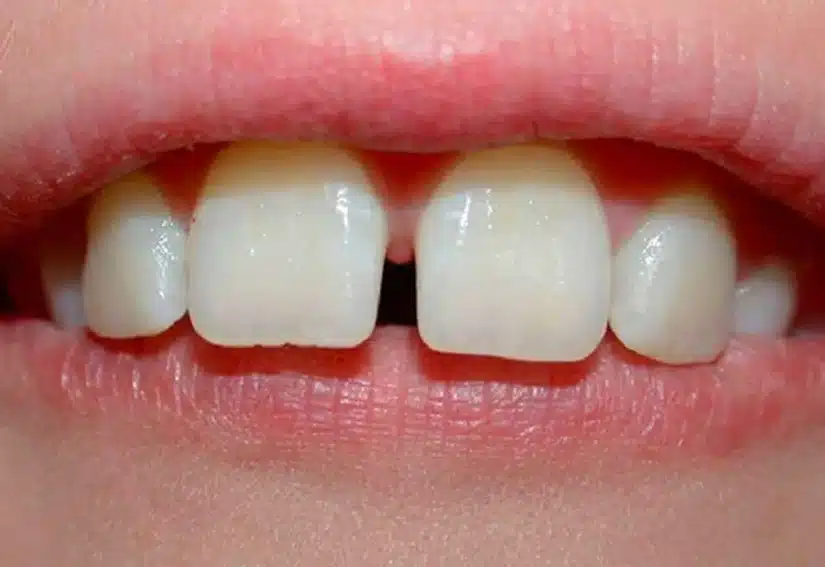 Niềng răng thưa: vì sao thưa răng, bao lâu hiệu quả?