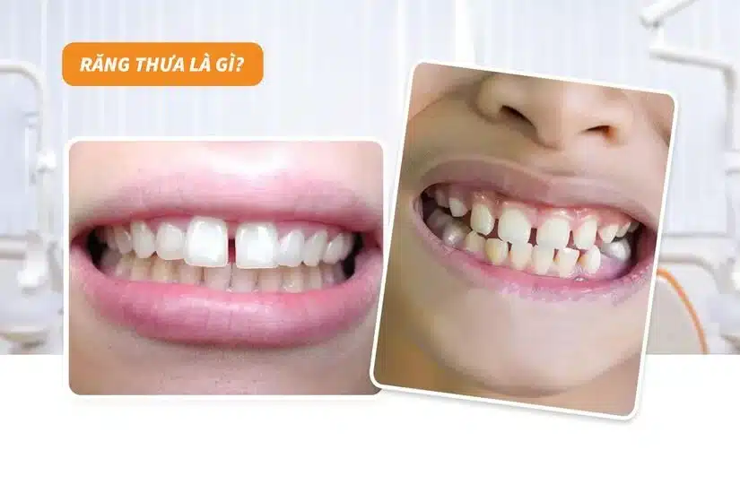 Niềng răng thưa: vì sao thưa răng, bao lâu hiệu quả?
