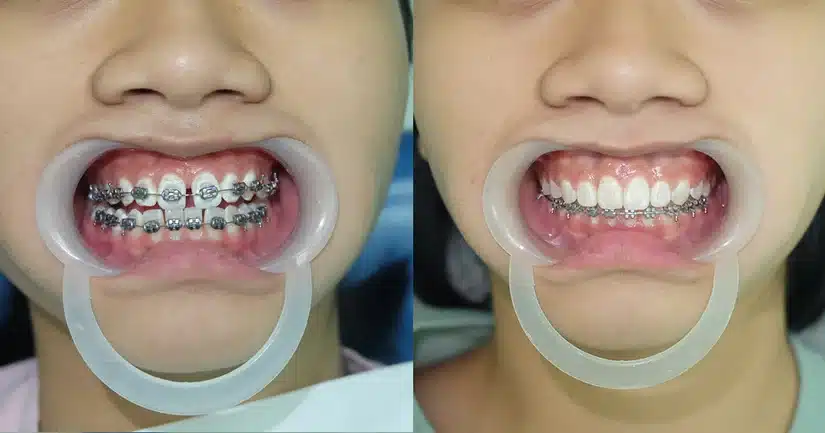 Niềng răng thưa: vì sao thưa răng, bao lâu hiệu quả?
