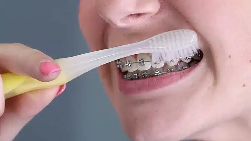 Niềng răng thưa: vì sao thưa răng, bao lâu hiệu quả?
