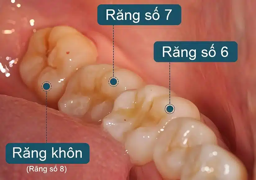 Răng khôn (răng số 8) là gì? Khi nào mọc?