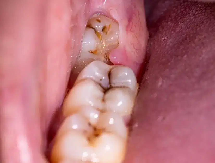 Răng khôn (răng số 8) là gì? Khi nào mọc?