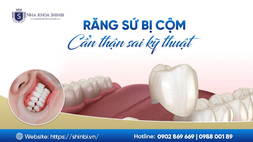 Răng sứ bị cộm, cấn – Dấu hiệu sai kỹ thuật