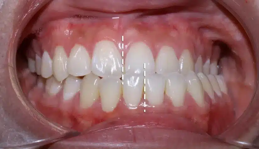 Xương hàm lệch có niềng răng được không?