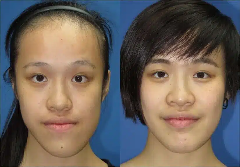 Xương hàm lệch có niềng răng được không?