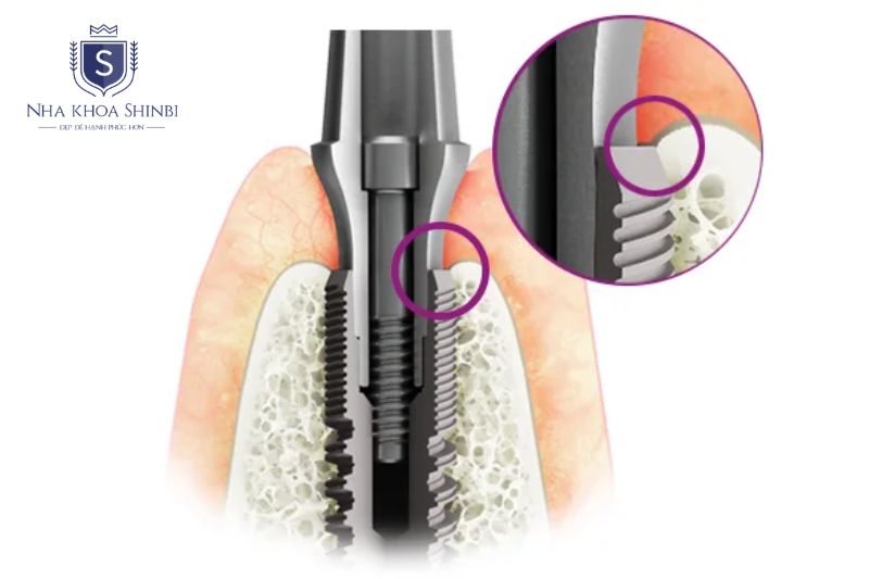 Abutment là phần kết nối giữa trụ titanium và mão sứ