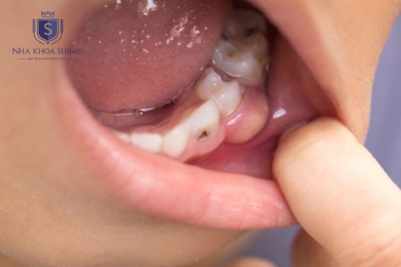 Áp xe răng gây sưng mủ sốt và cần điều trị khẩn để tránh biến chứng toàn thân