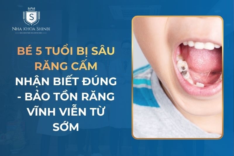 Bé 5 Tuổi Bị Sâu Răng Cấm: Dấu Hiệu Nhận Biết Và Cách Điều Trị