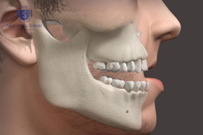 CT Cone Beam 3D giúp bác sĩ chọn loại trụ Implant phù hợp với mật độ và cấu trúc xương chính xác