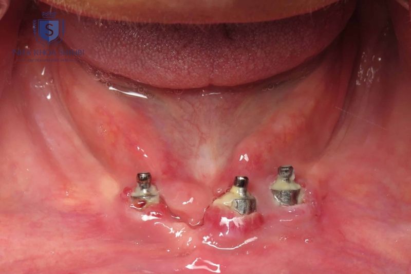 Cấy ghép Implant cần đảm bảo vô trùng để tránh biến chứng nguy hiểm