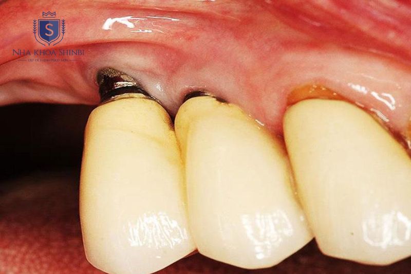 Cấy ghép Implant có chống chỉ định và cần đánh giá kỹ trước thực hiện
