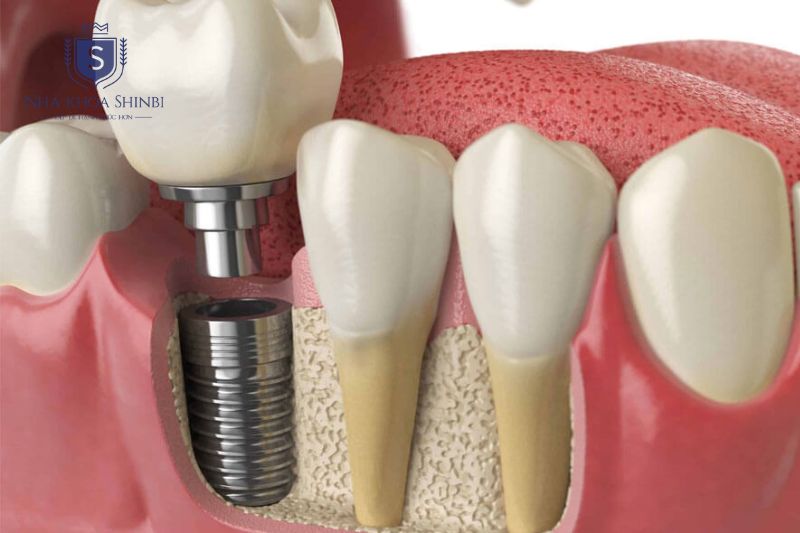 Cấy ghép Implant thay thế chân răng bằng trụ titanium tích hợp xương