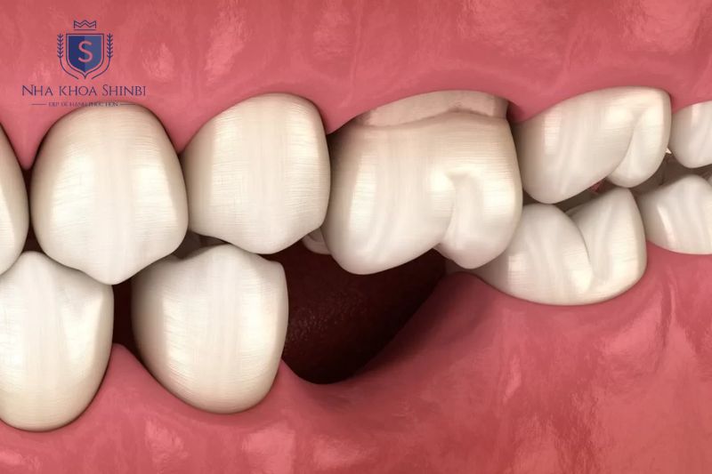 Chất lượng và mật độ xương hàm là yếu tố quan trọng nhất quyết định thời gian cấy implant
