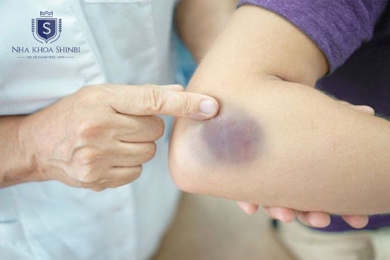 Chảy máu chân răng kéo dài có thể liên quan rối loạn đông máu, gan, tiểu đường hoặc ung thư máu