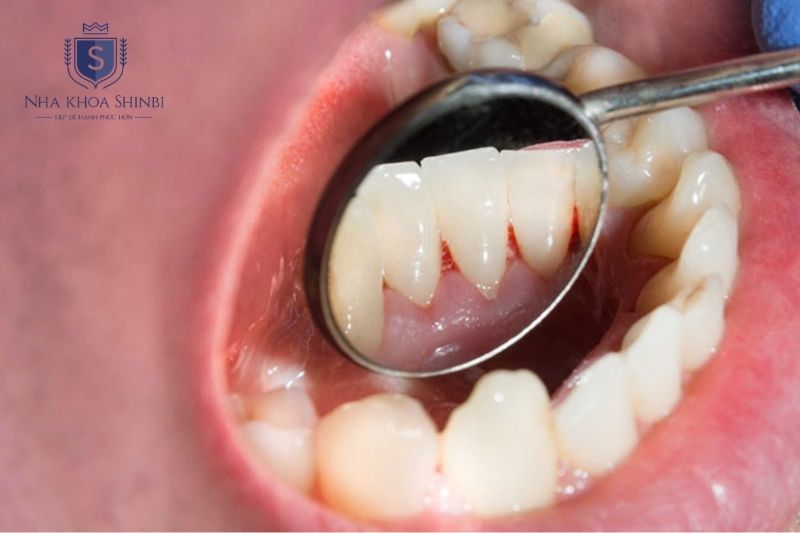 Chảy máu chân răng kéo dài kèm sưng đau hoặc mủ có thể cảnh báo bệnh lý nghiêm trọng