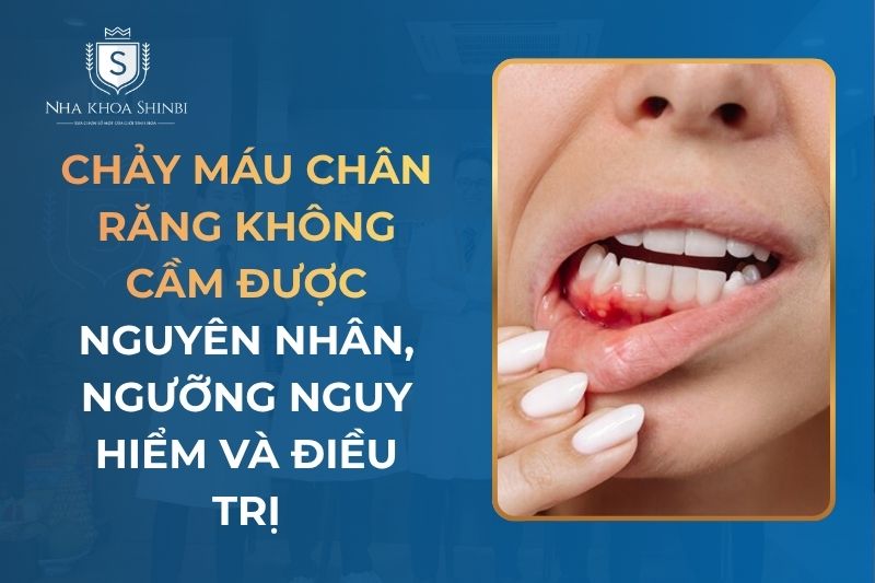 Chảy Máu Chân Răng Không Cầm Được Có Nguy Hiểm Không? Nguyên Nhân Và Cách Điều Trị
