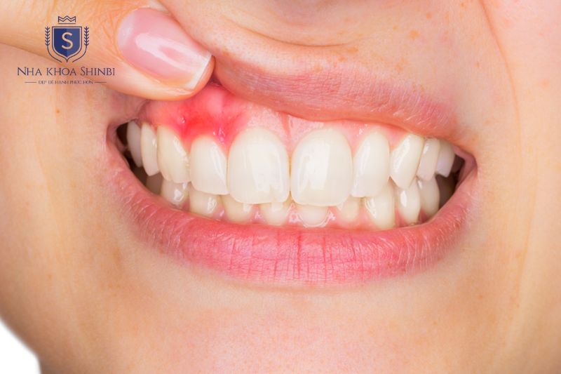 Chảy máu nướu và hôi miệng kéo dài là dấu hiệu viêm lợi thường gặp