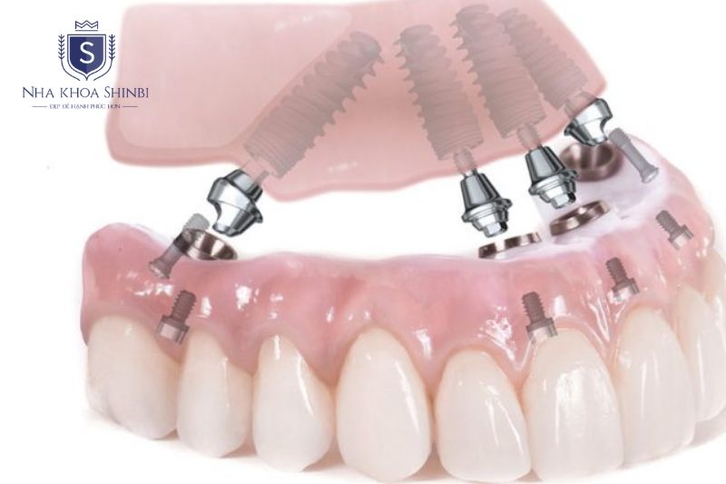 Chi phí All-on-4 và All-on-6 tại Nha Khoa Shinbi theo loại trụ