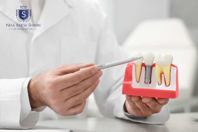 Chi phí Implant phụ thuộc loại trụ, tình trạng xương, vị trí răng, mão sứ và số lượng răng mất