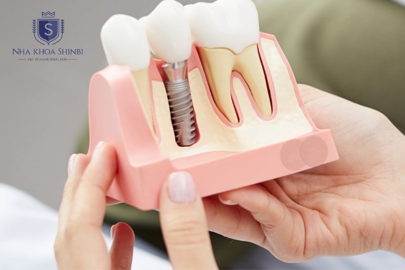 Chi phí Implant phụ thuộc mão sứ, xương, dòng trụ và số lượng tại Shinbi