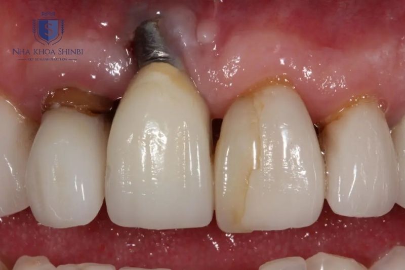 Đào thải trụ implant xảy ra khi tích hợp xương thất bại do nhiều yếu tố