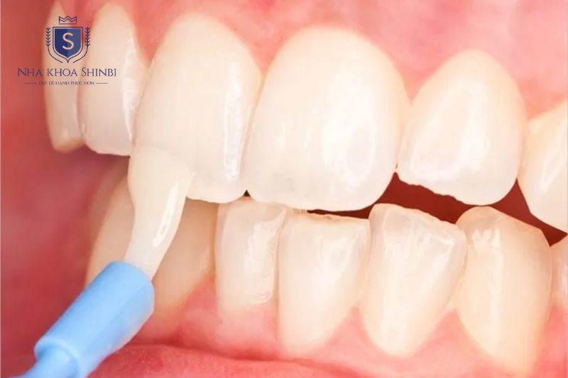 Điều trị florua giúp tái khoáng men răng và hiệu quả ở giai đoạn sâu sớm