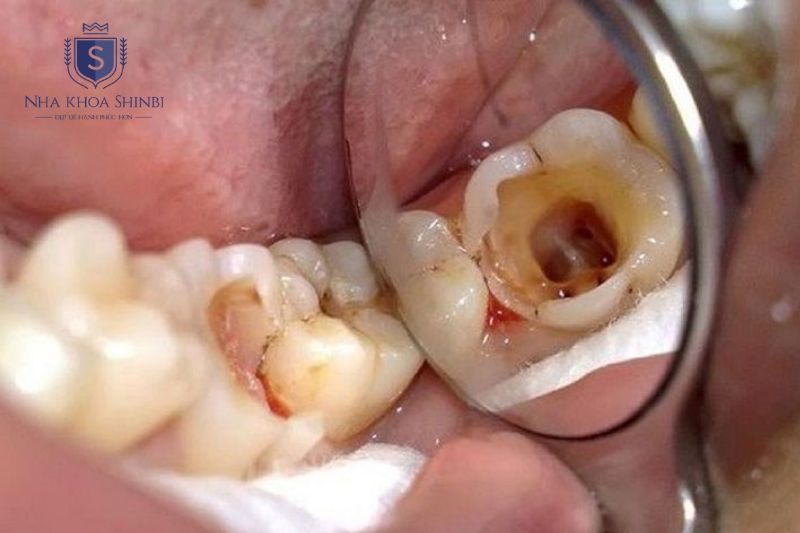 Đốm trắng ê buốt đau nhức lỗ sâu và hôi miệng là dấu hiệu sâu răng sớm