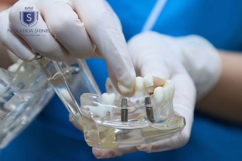 Gắn abutment và mão sứ sau khi trụ Implant tích hợp xương hoàn tất