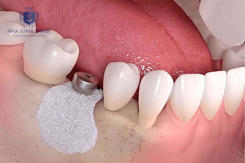 Ghép xương áp dụng khi tiêu xương trung bình giúp tái tích hợp và giữ trụ implant ổn định