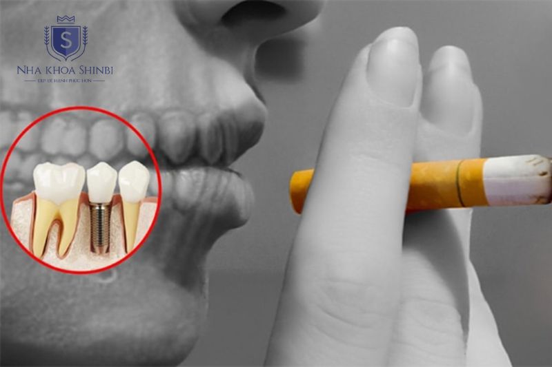 Hút thuốc sau cấy ghép làm tăng nguy cơ đào thải trụ và chậm lành thương