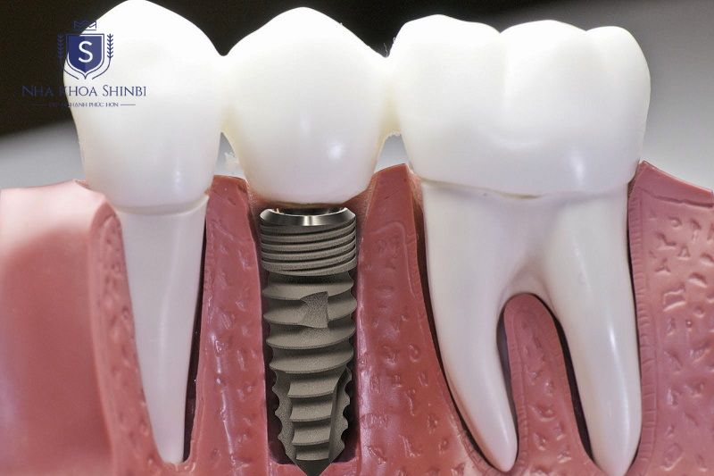 Implant Kontact là lựa chọn phù hợp khi bệnh nhân có xương hàm đủ mật độ và chiều cao