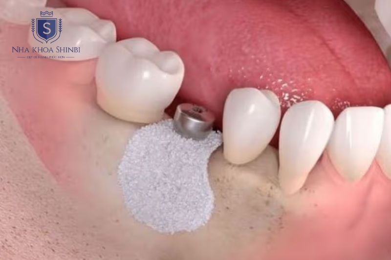 Implant thường hoàn tất sau 3 đến 6 tháng tùy tình trạng xương và can thiệp bổ sung