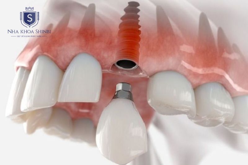 Implant tức thì đặt trụ ngay sau nhổ răng khi xương đủ