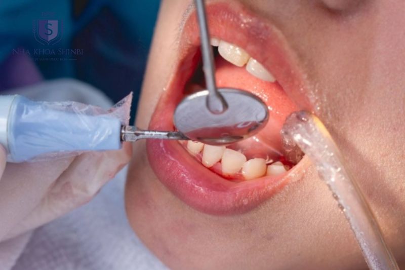 Lấy cao răng là bước điều trị quan trọng giúp nướu phục hồi khỏe mạnh