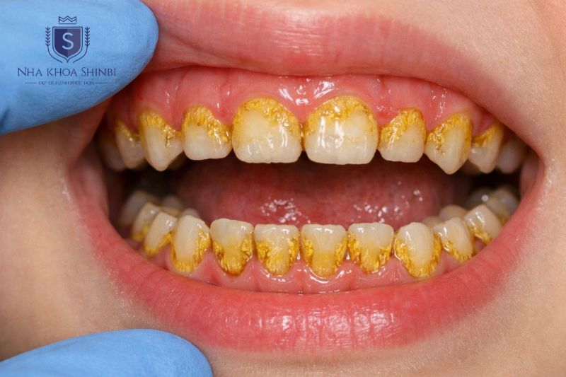 Mảng bám và cao răng là nguyên nhân phổ biến gây viêm lợi kéo dài
