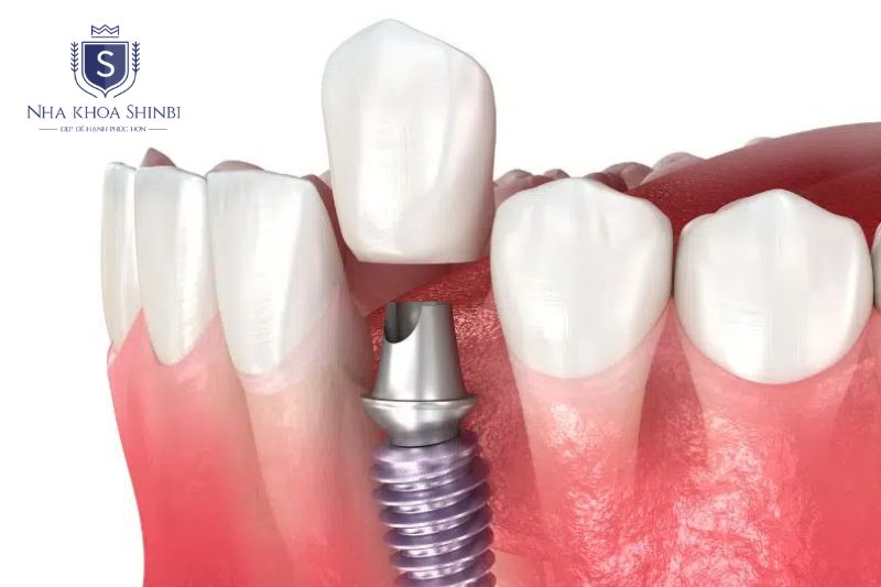 Mão sứ và abutment là chi phí thiết yếu ảnh hưởng tổng Implant tại nha khoa Shinbi