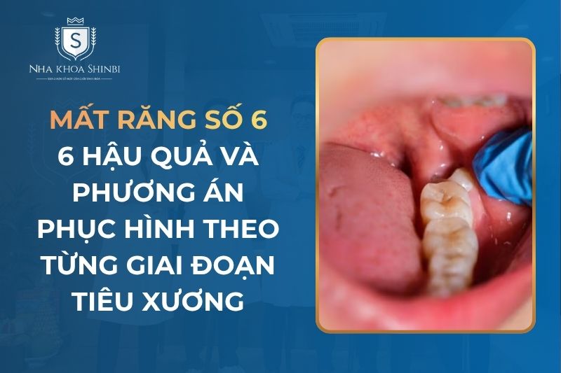 Mất Răng Số 6: Hậu Quả Và Phương Pháp Điều Trị