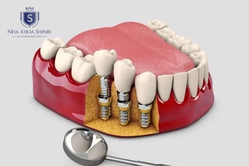 Một số bệnh lý cần đánh giá kỹ trước khi thực hiện cấy ghép implant
