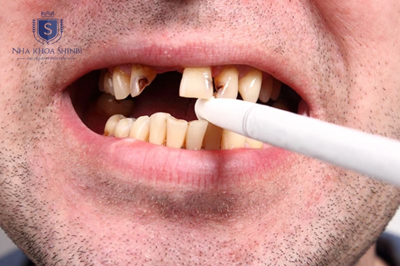 Người hút thuốc lá dễ bị viêm lợi